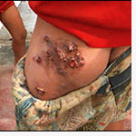 Pieles ulceradas en Ranipet (India)